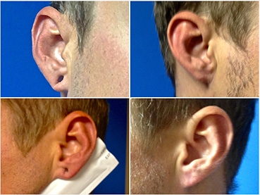 Ear Gauge Repair Male