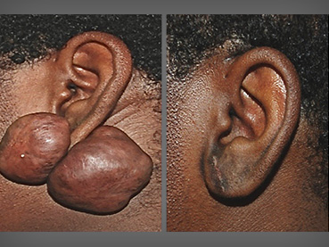 Ear Keloid Removal Case #2