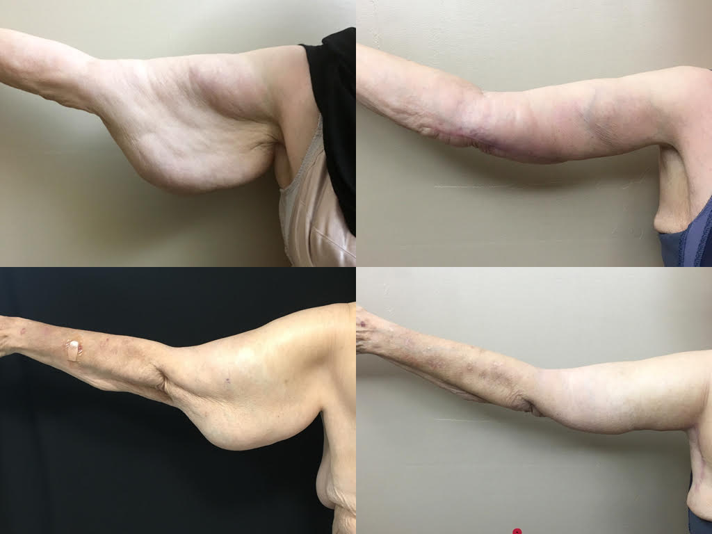 Brachioplasty / Arm Lift