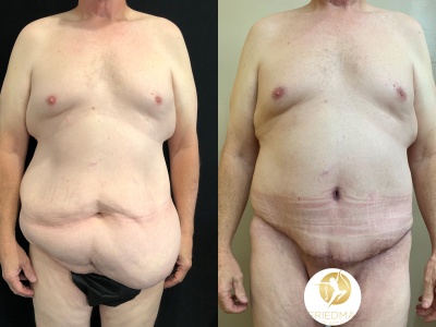 Abdominoplasty with Posterior Lower Body Lift Case #2